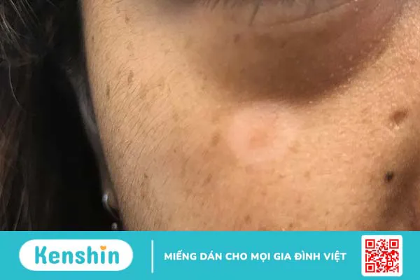 Halo nevus: Nguyên nhân, triệu chứng và cách điều trị