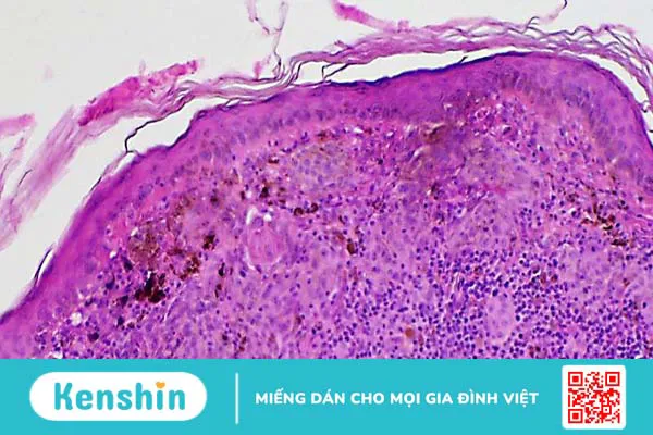 Halo nevus: Nguyên nhân, triệu chứng và cách điều trị