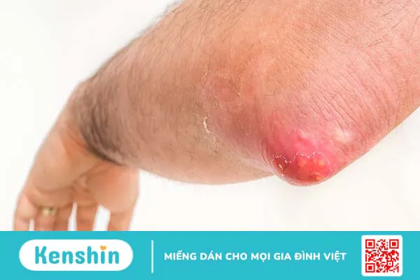 Hậu bối là bệnh gì? Nguyên nhân, triệu chứng và cách phòng ngừa