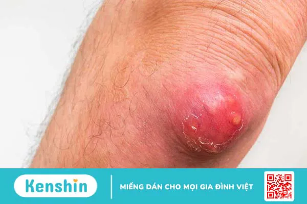 Hậu bối là bệnh gì? Nguyên nhân, triệu chứng và cách phòng ngừa