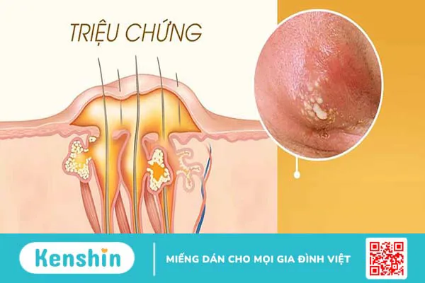 Hậu bối là bệnh gì? Nguyên nhân, triệu chứng và cách phòng ngừa