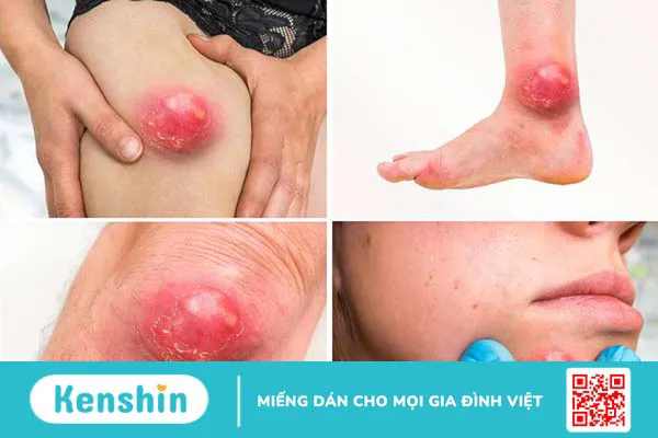 Hậu bối là bệnh gì? Nguyên nhân, triệu chứng và cách phòng ngừa