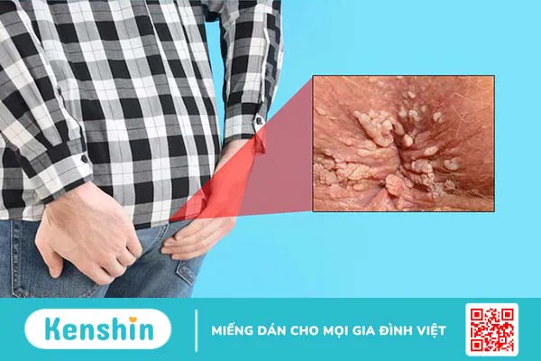 Hậu môn nổi mụn thịt: Nguyên nhân và cách điều trị