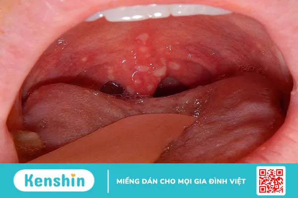 Herpangina là bệnh gì? Có nguy hiểm không?