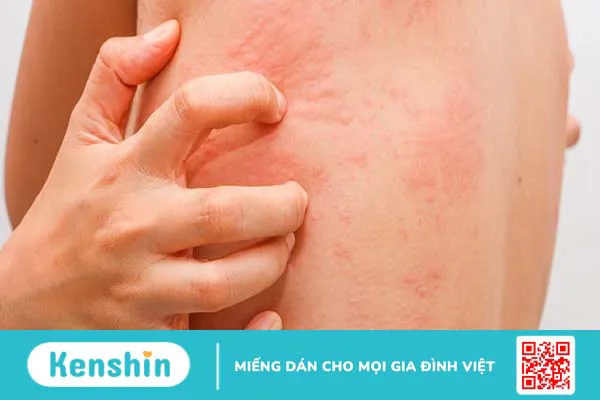 Hết nổi mề đay hiệu quả với dung dịch xịt ngoài da Skin Herbal