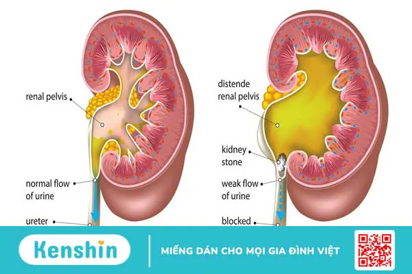 Hiện tượng giãn đài bể thận bẩm sinh ở thai nhi có nguy hiểm không?