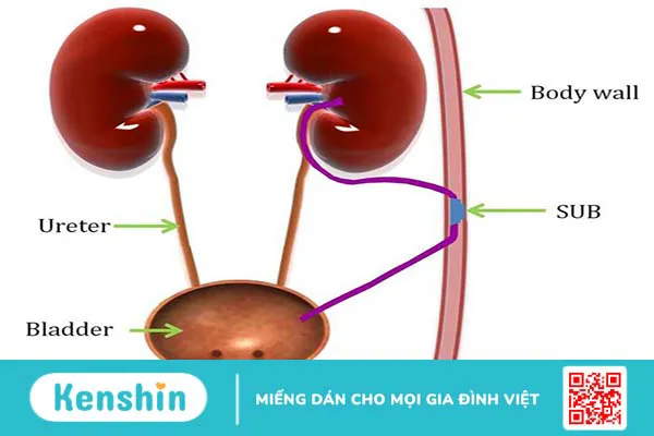 Hiện tượng giãn đài bể thận bẩm sinh ở thai nhi có nguy hiểm không?  2