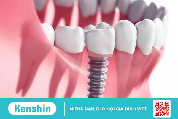 Hiểu rõ về cấu tạo implant trong phục hồi răng