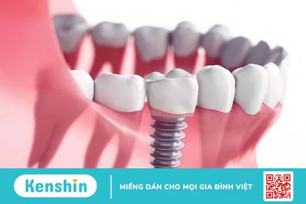 Hiểu rõ về cấu tạo implant trong phục hồi răng