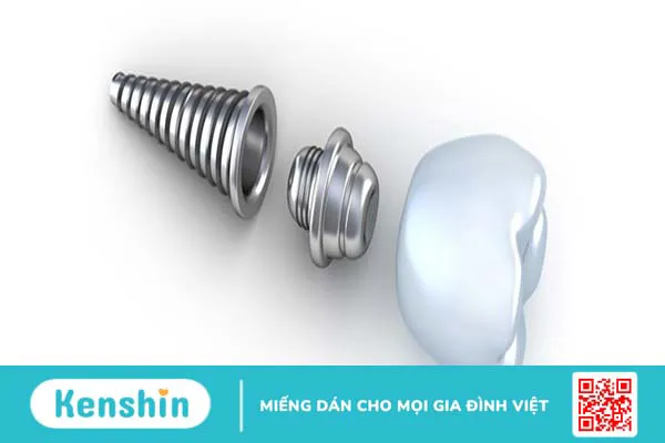 Hiểu rõ về cấu tạo implant trong phục hồi răng