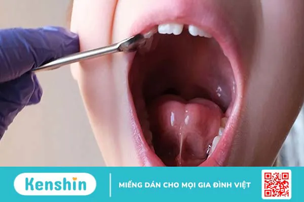 Hình ảnh dính thắng lưỡi ở trẻ và phương pháp điều trị