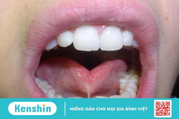 Hình ảnh dính thắng lưỡi ở trẻ và phương pháp điều trị