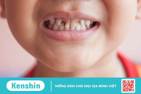 Hình ảnh dính thắng lưỡi ở trẻ và phương pháp điều trị