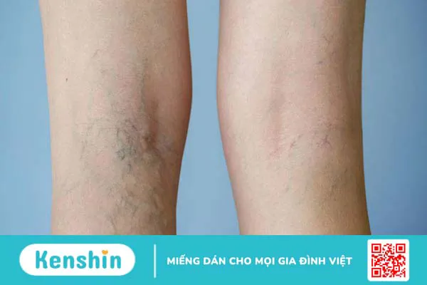 Hỗ trợ điều trị suy giãn tĩnh mạch với vớ đùi y khoa Biohealth Compression I