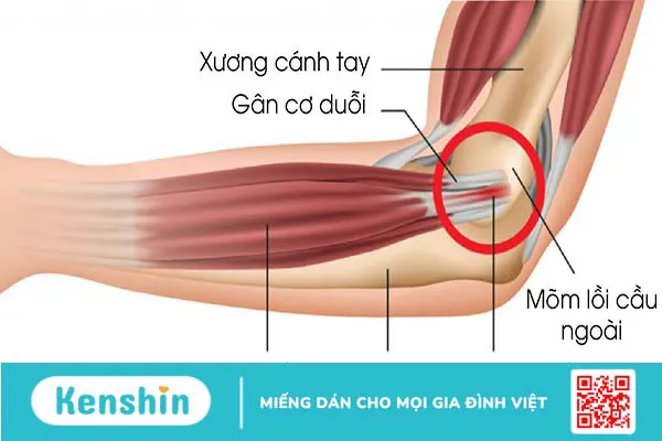 Hội chứng Tennis Elbow là gì? Cách điều trị hiệu quả nhất