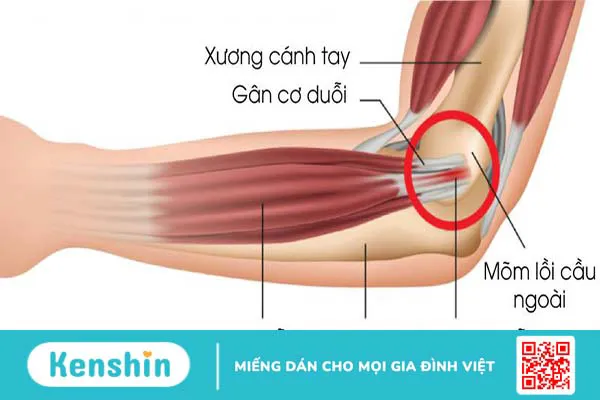 Hội chứng Tennis Elbow là gì? Cách điều trị hiệu quả nhất