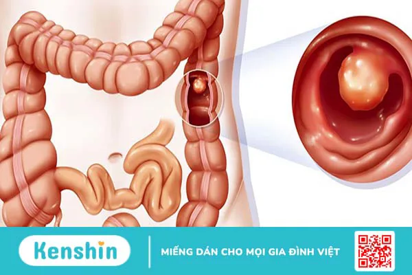 Hỏi đáp: Kết quả sinh thiết polyp đại tràng ác tính khi nào?