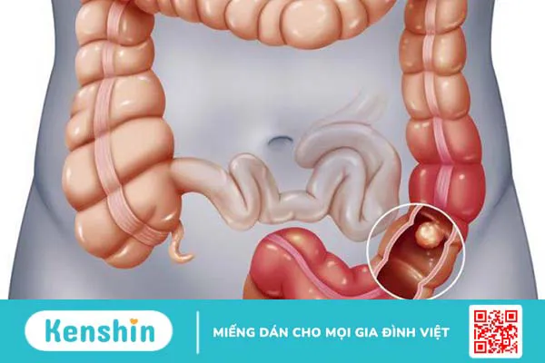 Hỏi đáp: Kết quả sinh thiết polyp đại tràng ác tính khi nào?