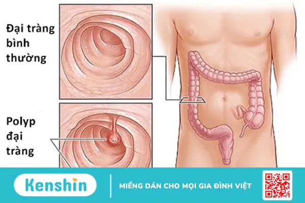 Hỏi đáp: Kết quả sinh thiết polyp đại tràng ác tính khi nào?