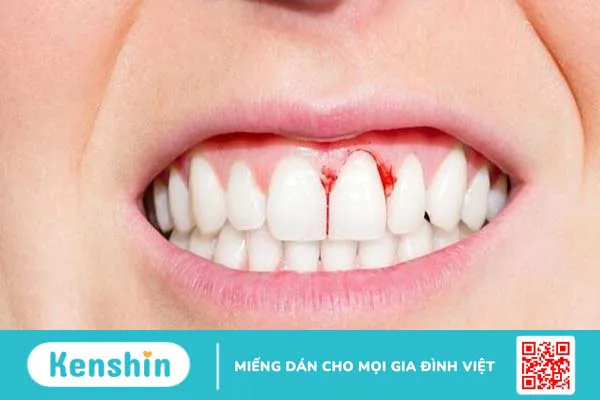 hôi miệng do viêm lợi khắc phục như thế nào 2