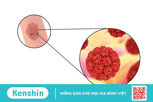 HPV type 58 và nguy cơ ung thư cổ tử cung