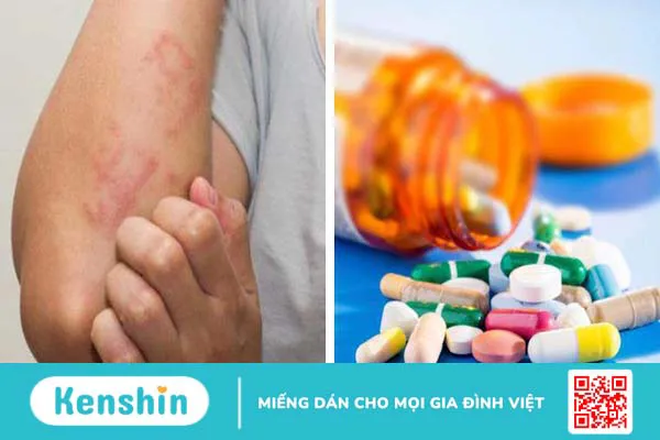 Hướng dẫn bạn cách chữa dị ứng thuốc kháng sinh tại nhà