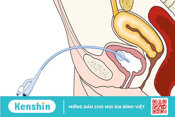 Hướng dẫn cách đặt ống thông tiểu nữ giới