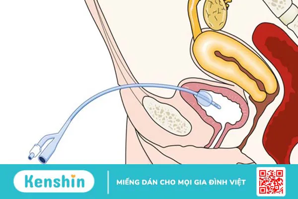 Hướng dẫn cách đặt ống thông tiểu nữ giới