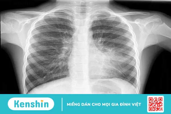 Cách lập kế hoạch chăm sóc bệnh nhân viêm phổi như thế nào? 3