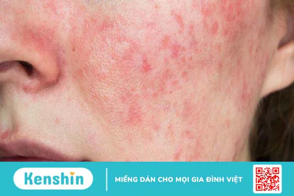 Hướng dẫn chi tiết cách dưỡng ẩm cho da tuổi dậy thì 2