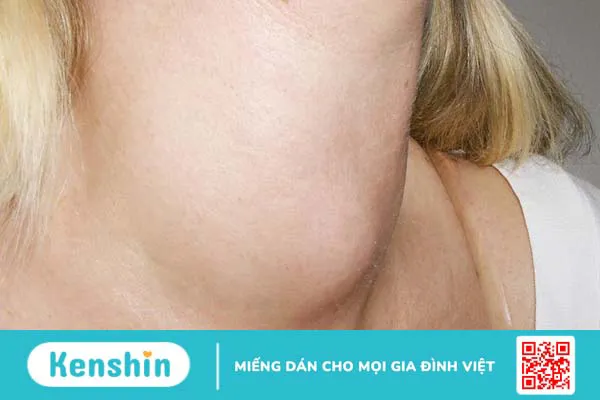 Hướng dẫn dùng lá sộp trị bướu cổ mà bạn có thể tham khảo