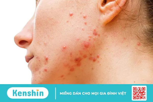 Hướng dẫn mẹ bỉm chăm sóc da mặt sau sinh