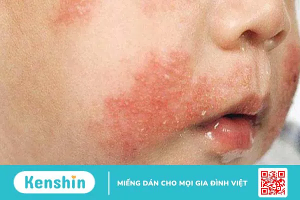 Hướng dẫn mẹ cách chăm sóc trẻ bị dị ứng đạm sữa bò