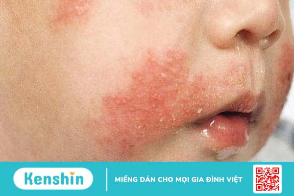 Hướng dẫn mẹ cách chăm sóc trẻ bị dị ứng đạm sữa bò 1