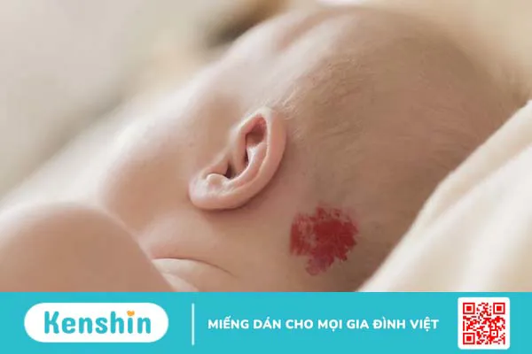 Hướng dẫn phân biệt bướu máu và bướu huyết thanh