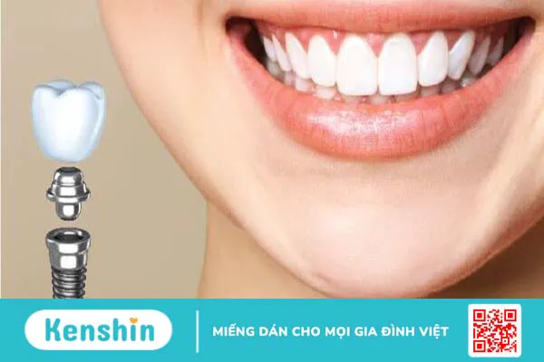 Implant SIC là gì? Trồng răng implant SIC có tốt không?