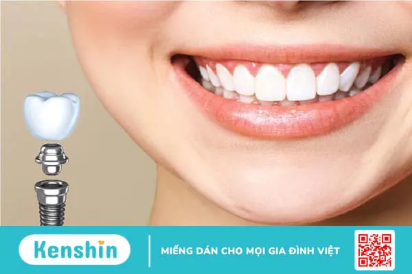 Implant sic là gì? Trồng răng implant sic có tốt không? 2