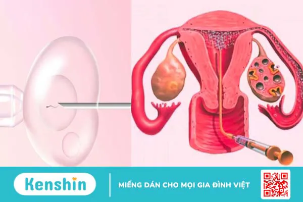 iui-va-ivf-la-gi-nen-lua-chon-phuong-phap-nao-giua-iui-va-ivf 2.webp