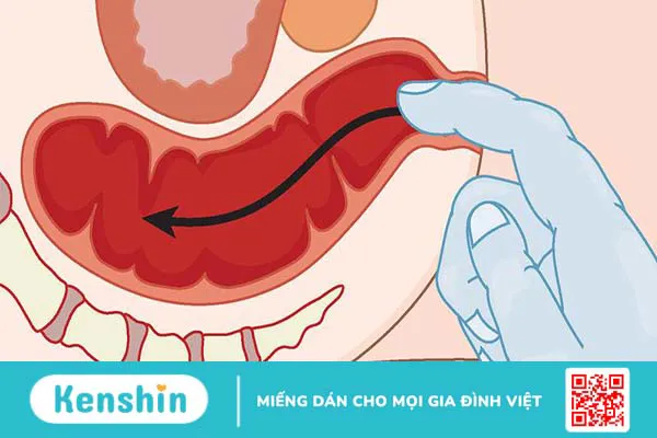 Khám hậu môn trực tràng là khám những gì?