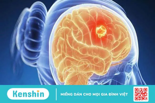 Khám u não ở đâu uy tín và chất lượng tại TP. Hồ Chí Minh?