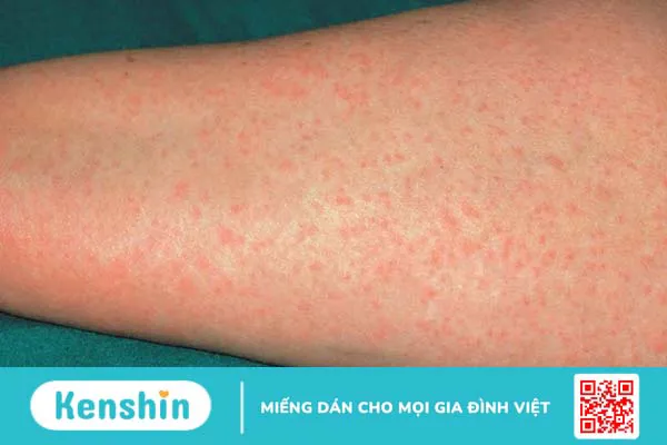 Kháng sinh nhóm Beta Lactam và những thông tin cần biết