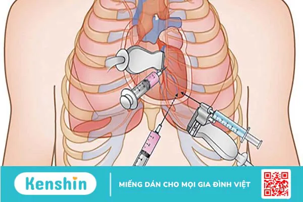 Khi nào cần dẫn lưu dịch màng ngoài tim?