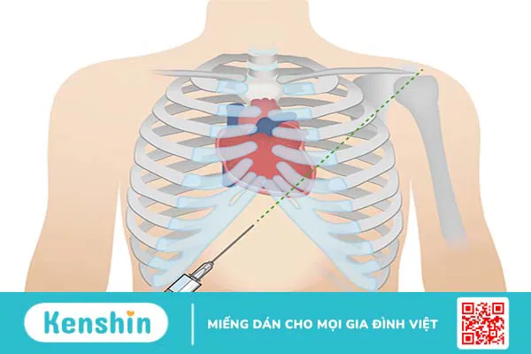 Khi nào cần dẫn lưu dịch màng ngoài tim?