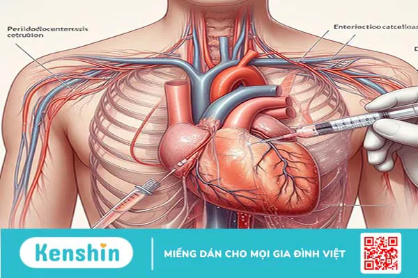 Khi nào cần dẫn lưu dịch màng ngoài tim?