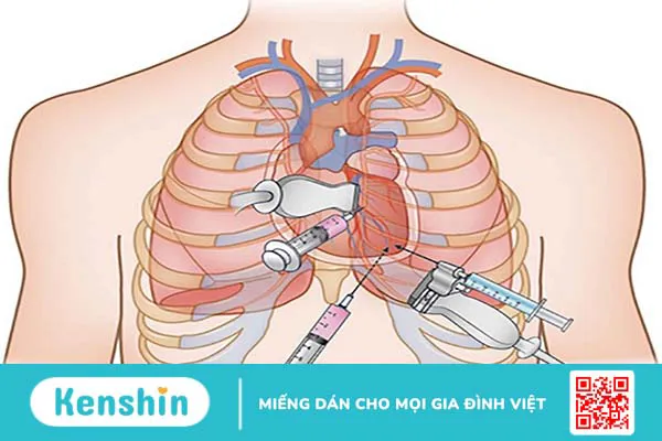 Khi nào cần dẫn lưu dịch màng ngoài tim?