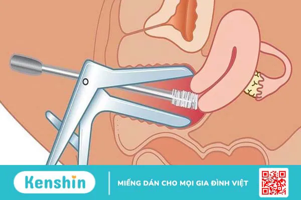 Khi nào cần khám phụ khoa bằng mỏ vịt?