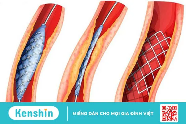 Khi nào cần tạo hình niệu quản? Các phương pháp tạo hình niệu quản hiện nay