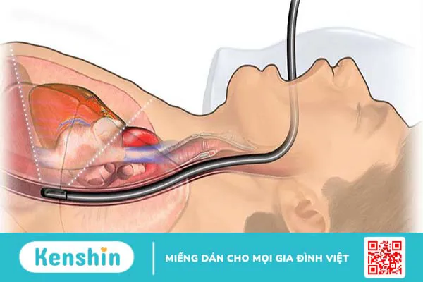 Khiếm khuyết tâm nhĩ là gì? Triệu chứng và cách chẩn đoán