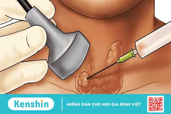 Khoảng cách giữa 2 lần chọc sinh thiết tuyến giáp là bao lâu?