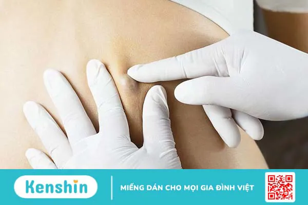 Khối u và nang giống hay khác nhau? Cách điều trị khối u và u nang